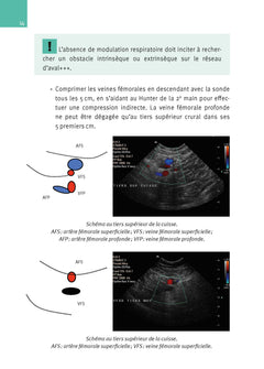 Échographie doppler vasculaire