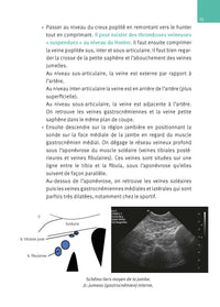 Échographie doppler vasculaire