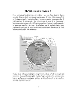 Le guide de la correction de la myopie