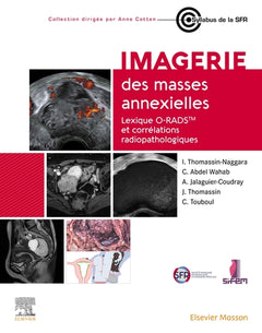 Imagerie des masses annexielles