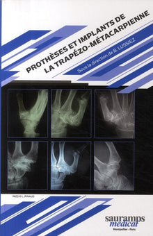 Prothèses et implants de la trapèze-métacarpienne