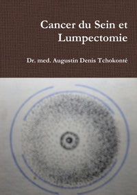 Cancer du Sein et Lumpectomie