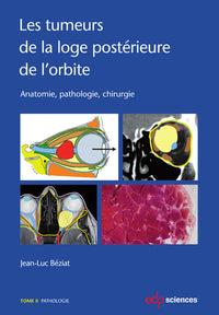 Les tumeurs de la loge postérieure de l'orbite - Tome 2