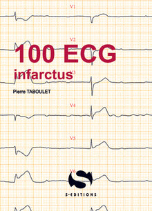 100 ecg autour de l'infarctus