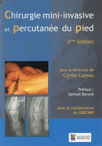 Chirurgie mini-invasive percutanée du pied 2ed
