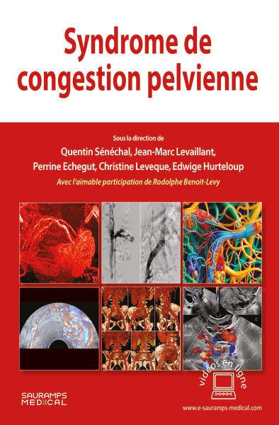 Syndrome de congestion pelvienne