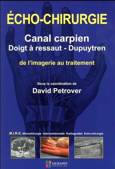 Echo-chirurgie Canal Carpien, Doigt à Ressaut et Dupuytren
