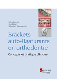 Brackets auto-ligaturants en orthodontie
